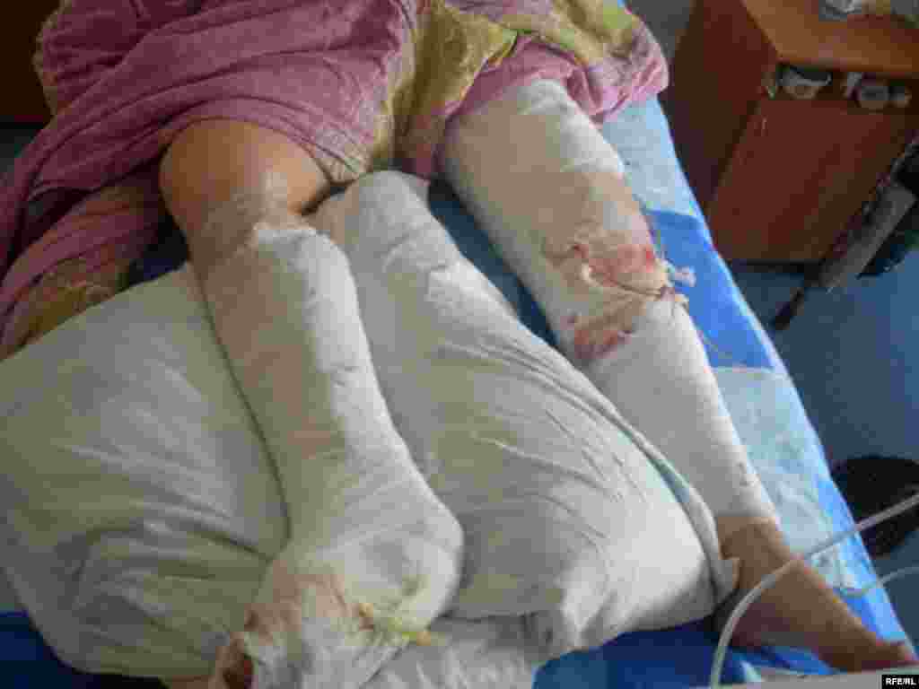 Victim Lilia Melnik, 28, said she was sitting with friends next to pine trees when the bomb went off. She received treatment at the hospital to have metal fragments removed from her legs.
